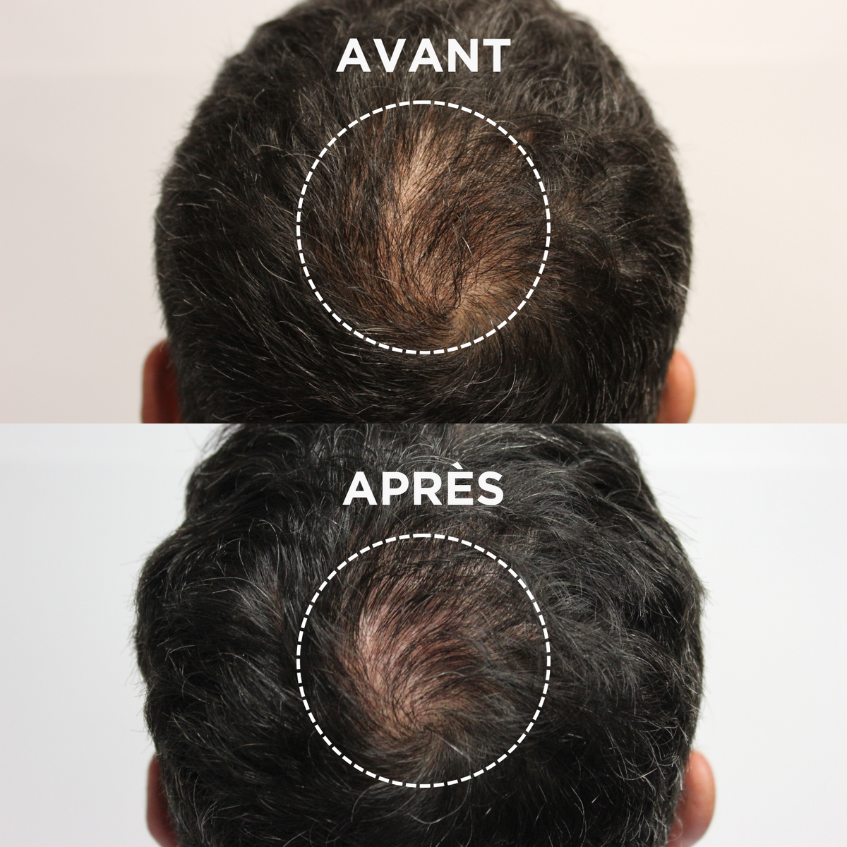 Que faire contre la chute de cheveux ?