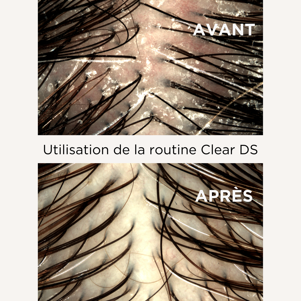 Shampoing Clear DS (Shampoing kérato-réducteur anti-pelliculaire)