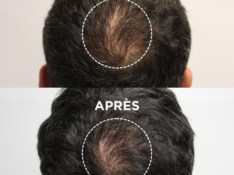 Que faire contre la chute de cheveux ?